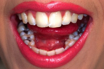 Zahnfuellung