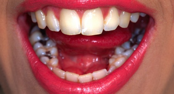 Zahnfuellung